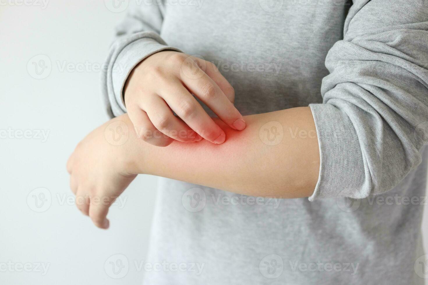 jovem mulher asiática coçando e coçando no braço de dermatite eczema de pele seca com coceira foto