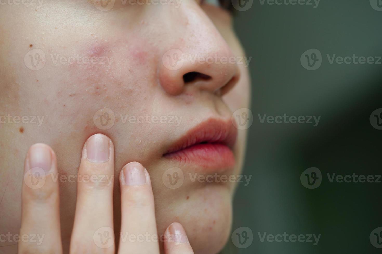 espinha de acne e cicatriz no rosto da pele, distúrbios das glândulas sebáceas, problema de beleza de cuidados com a pele de adolescente. foto