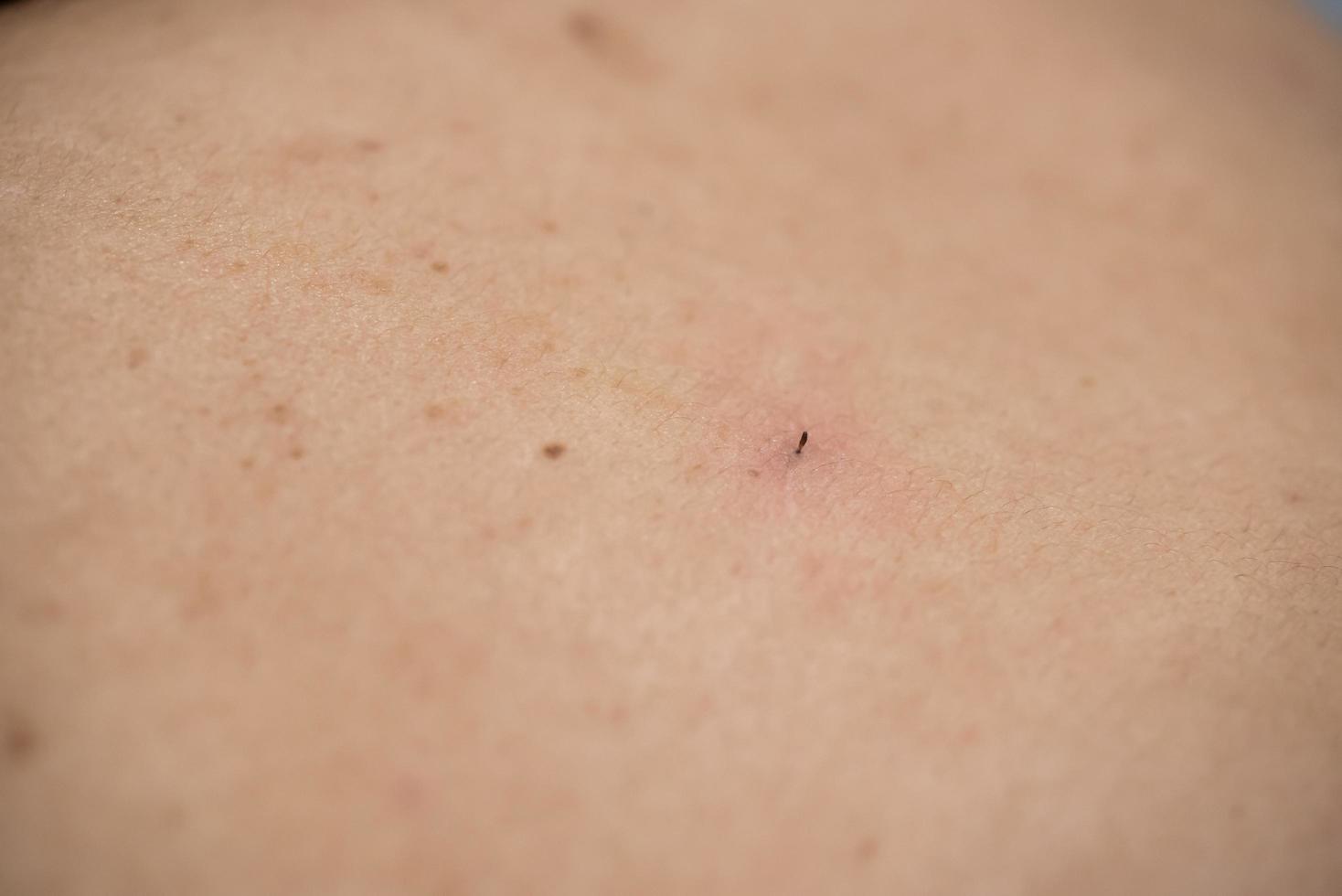acne na parte de trás da mulher de cuidados com a pele é causada por bactérias. foto