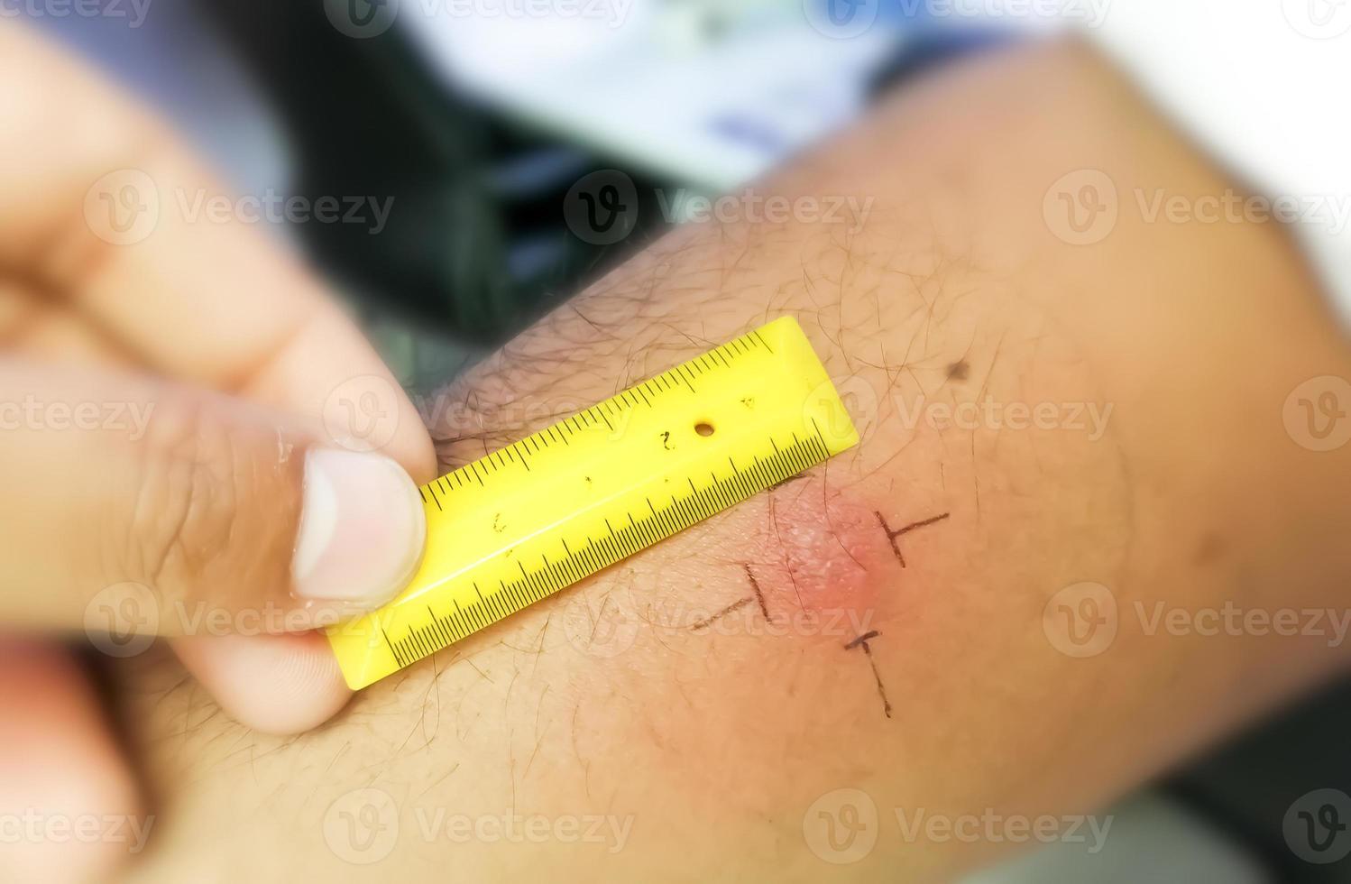 vacinação de mantoux, fotografia de visão aproximada do braço do paciente com reação de mancha vermelha à realização do teste de mantoux. paciente tuberculoso positivo. foto