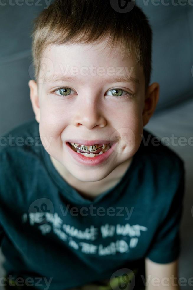 retrato de close-up de um menino de aparelho. correção de mordida em crianças. o menino usa uma placa dentária. a criança sorri com aparelho na boca. design sofisticado para corrigir dentes tortos foto