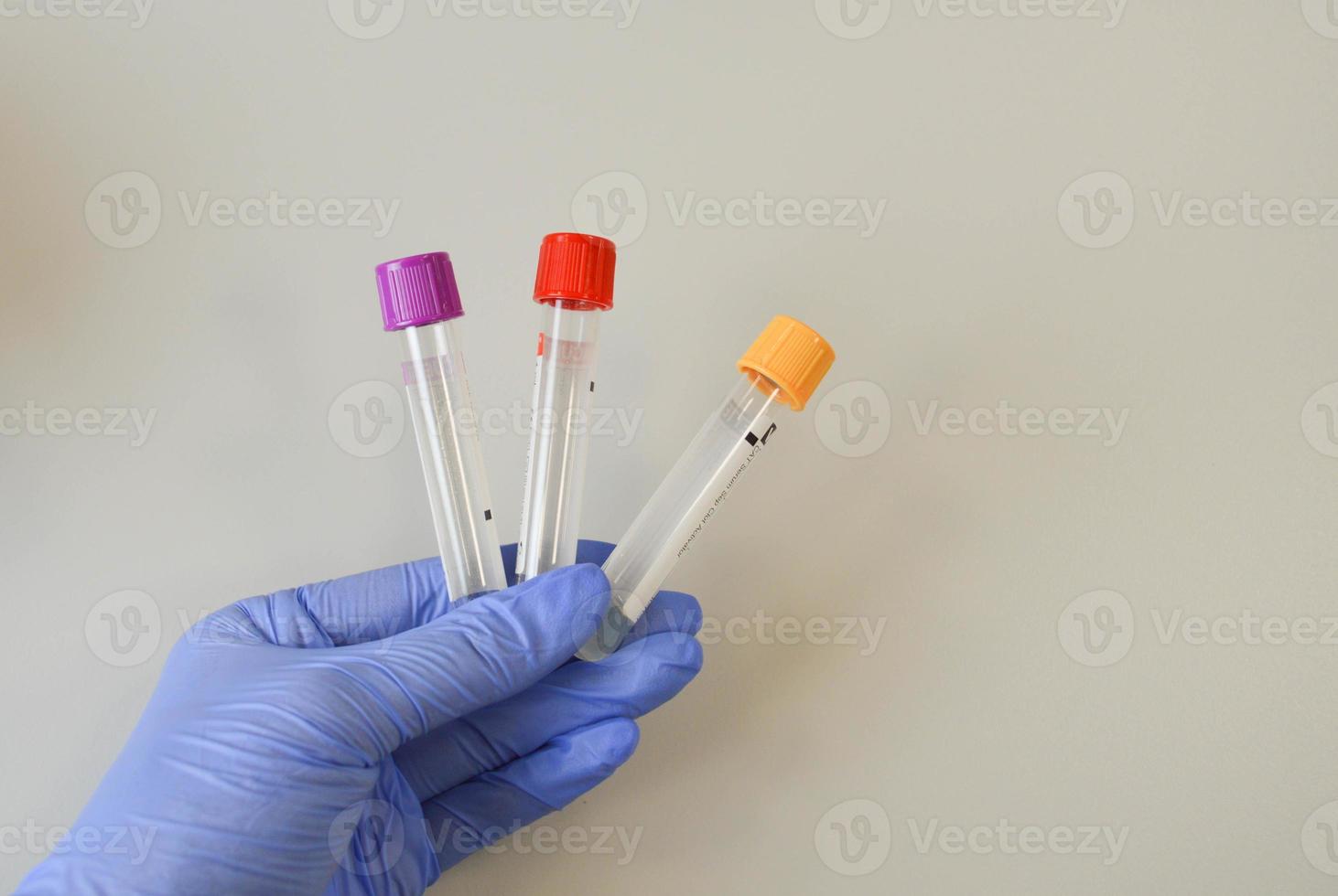 enfermeira segurando tubo de exame de sangue com resultado do teste de coronavírus. laboratórios de diagnóstico de vírus 2019-ncov foto