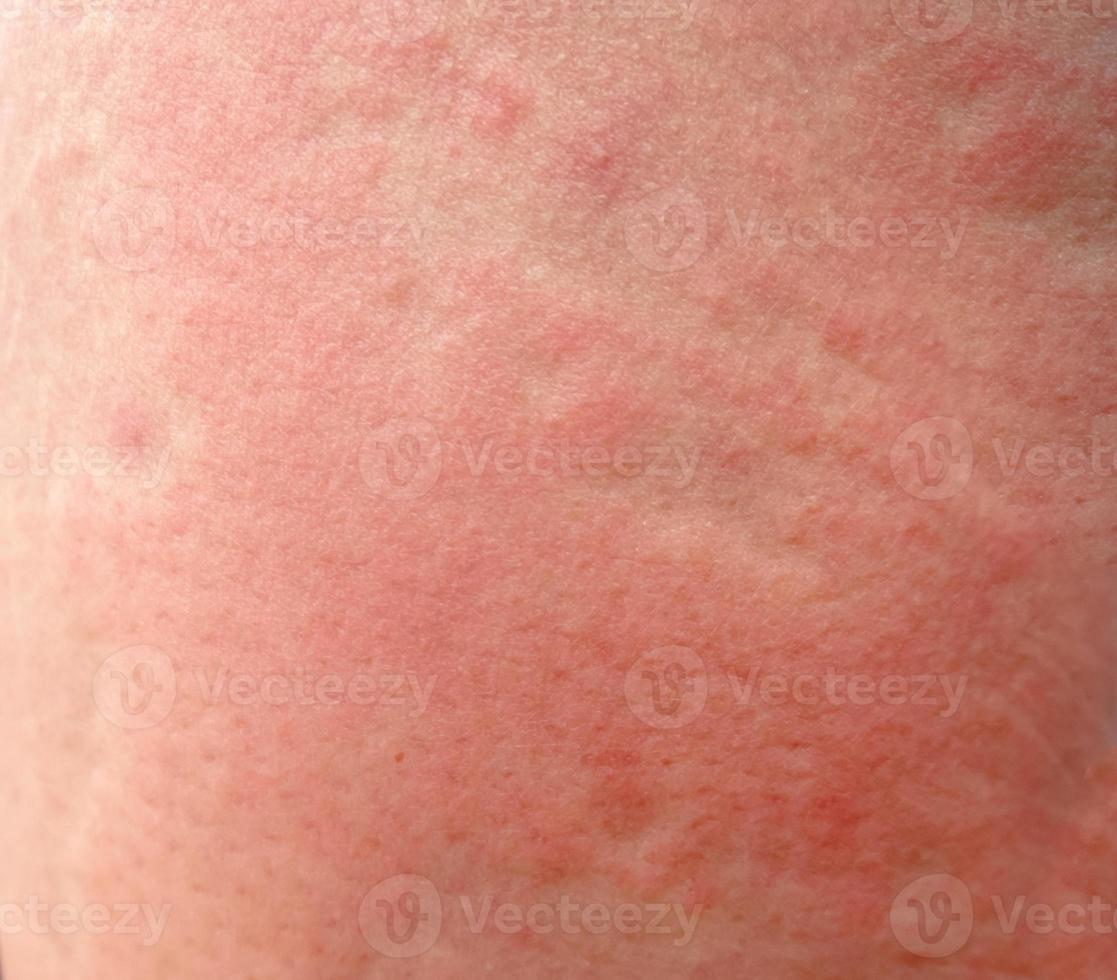 fortes erupções alérgicas na coxa. imunidade prejudicada e reação a produtos alergênicos. erupção dermatológica na pele e no corpo o problema de saúde e cosmetologia. foto