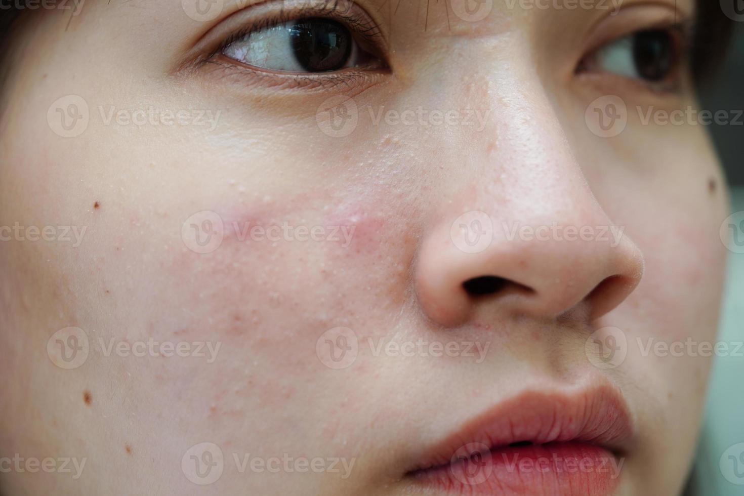 espinha de acne e cicatriz no rosto da pele, distúrbios das glândulas sebáceas, problema de beleza de cuidados com a pele de adolescente. foto