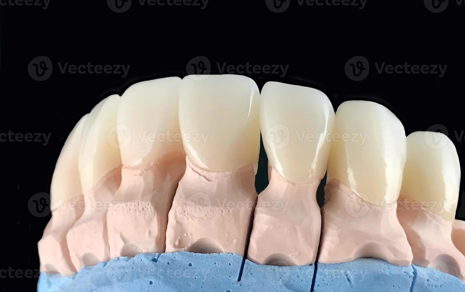 facetas e coroas de cerâmica de pressão de aparência natural em modelo de gesso dentário. coroa de dente de cerâmica de close-up. oficina de fabricação de próteses dentárias. foco seletivo. implante dentário. restauração de dentes foto