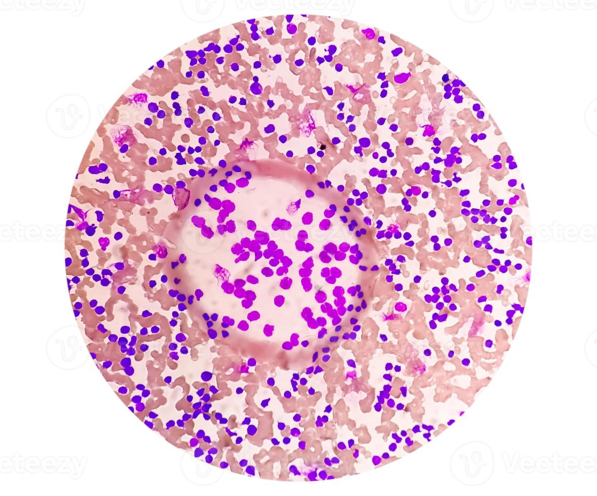 esfregaço de sangue sob microscopia mostrando leucemia linfoblástica crônica ou cll foto