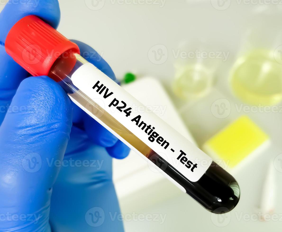 teste do antígeno p24 do hiv para o diagnóstico precoce da infecção pelo hiv. foto