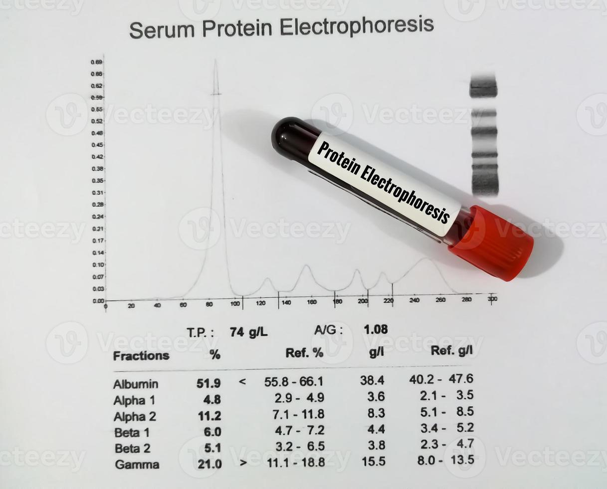 amostra de sangue e laudo do paciente isolada para teste de eletroforese de proteínas. fechar-se. foto