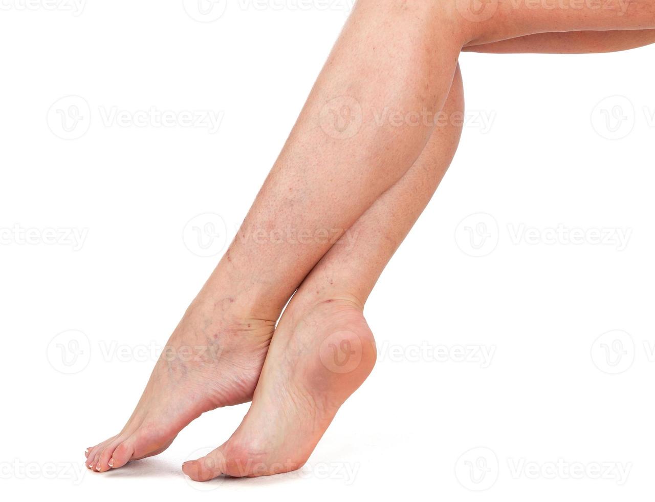 pernas de uma mulher. pele com estrelas vasculares. fundo branco foto