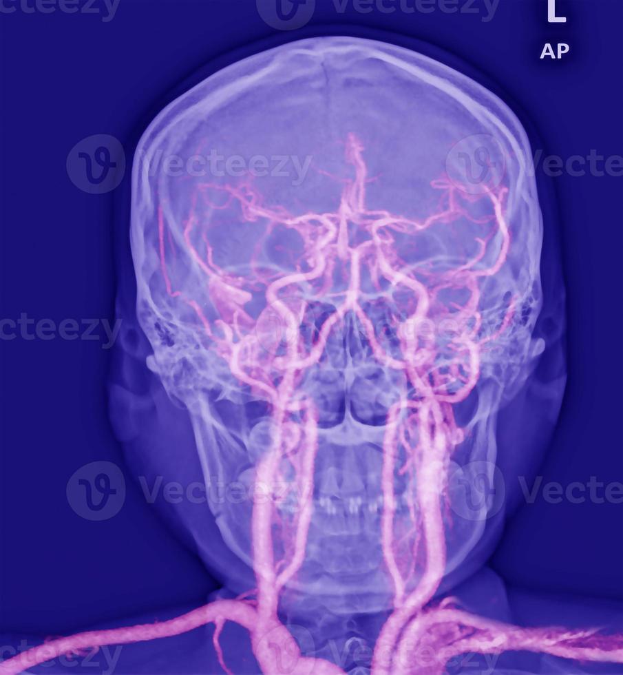 angiografia por ressonância magnética das artérias vasculares cerebrais foto