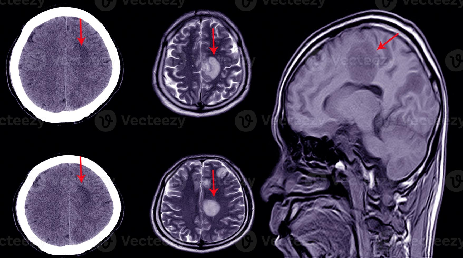 tomografia cerebral de um paciente com histórico de traumatismo craniano leve mostrando grande hematoma subdural subagudo foto