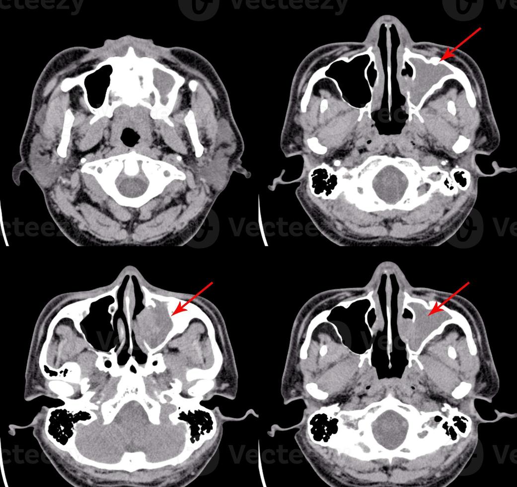 TC do cérebro e impressão dos seios paranasais sinusite crônica do seio maxilar lt. foto