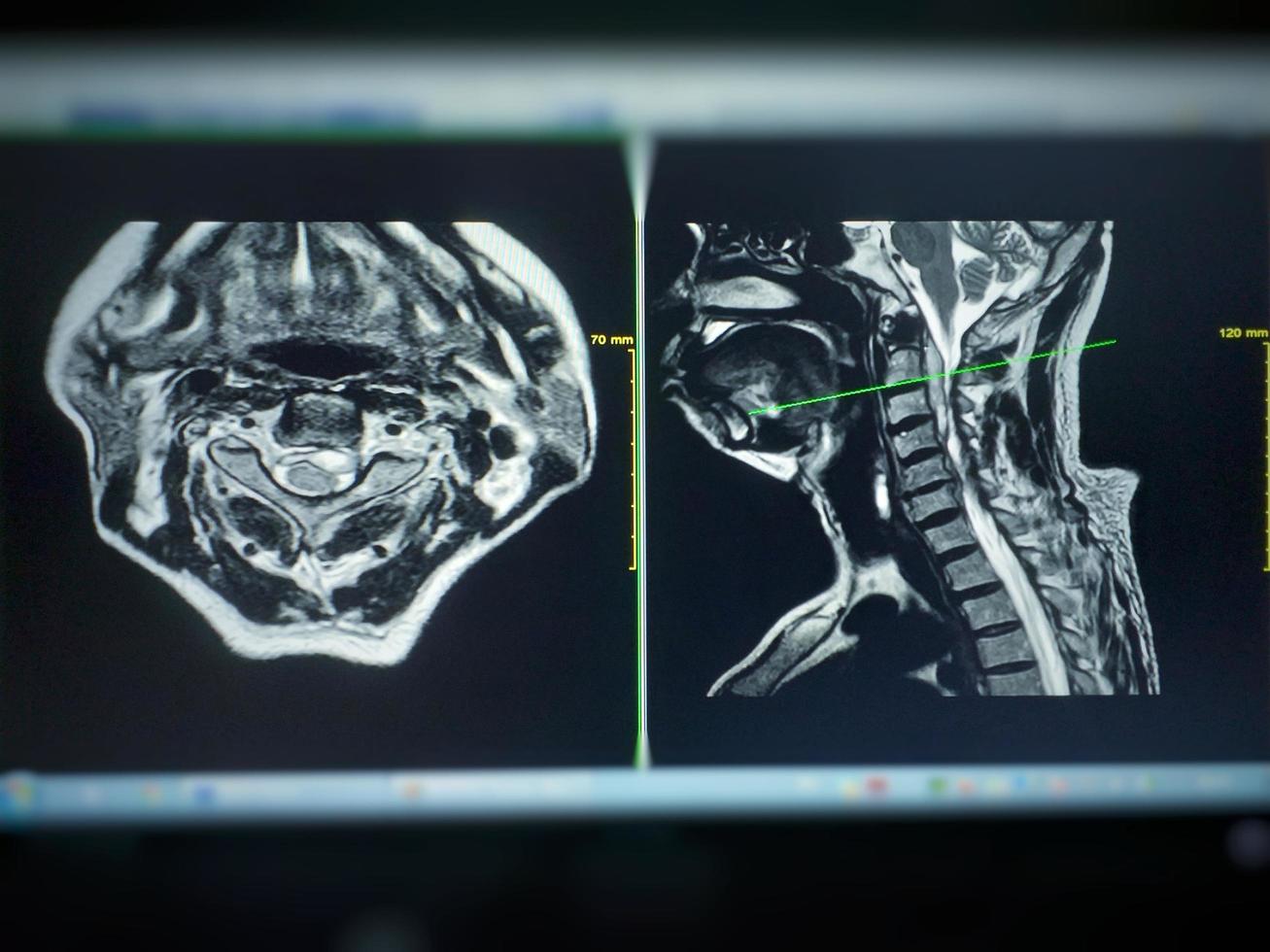 ressonância magnética da coluna cervical mostra compressão moderada da medula espinhal c4-c5 foto