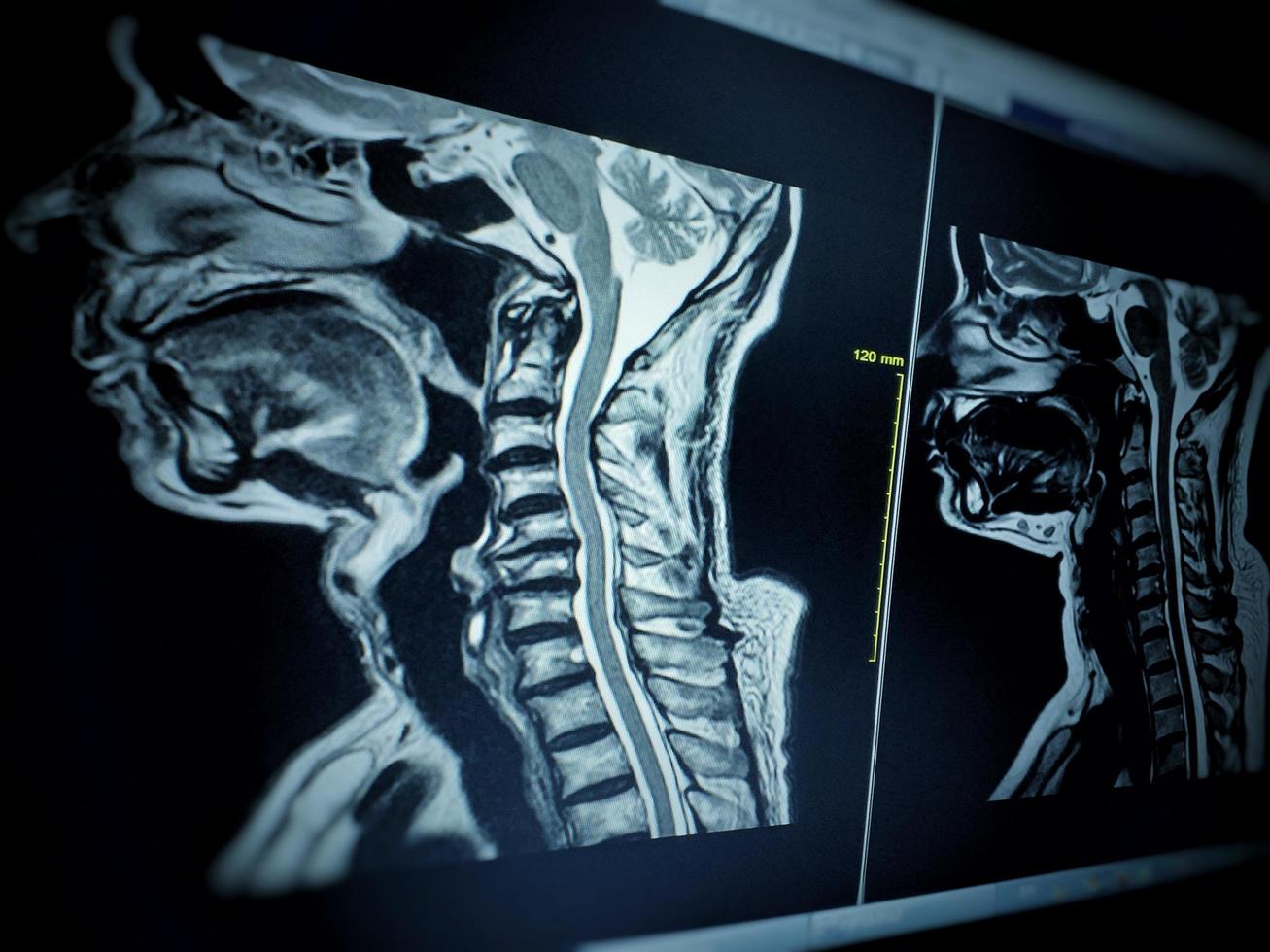 ressonância magnética da coluna cervical mostra compressão moderada da medula espinhal c4-c5 foto