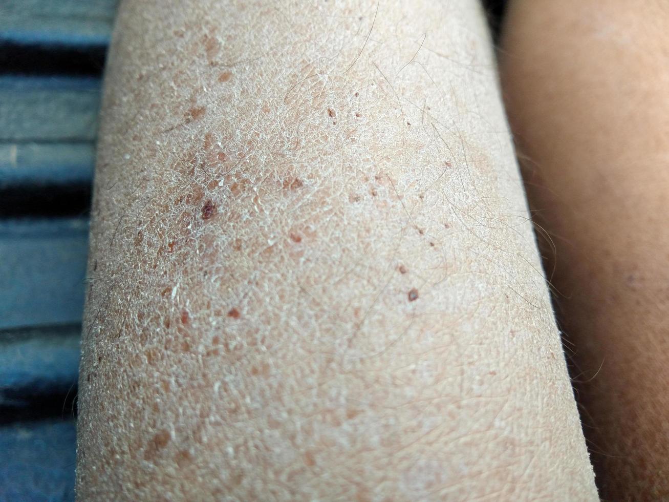 dermatite de conceito de pele rachada seca, eczema, loção de creme de micose cosmética foto