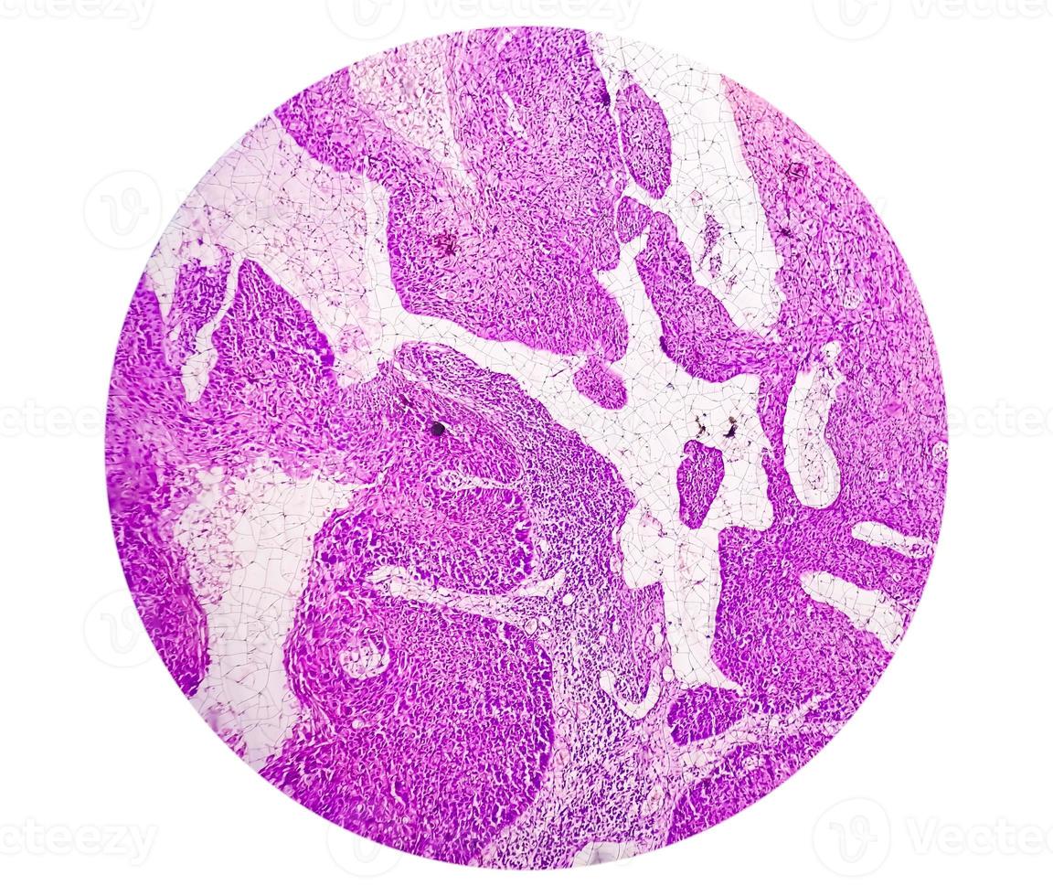 fotomicrografia mostrando carcinoma espinocelular de língua grau ii. scc invasivo oral. foto