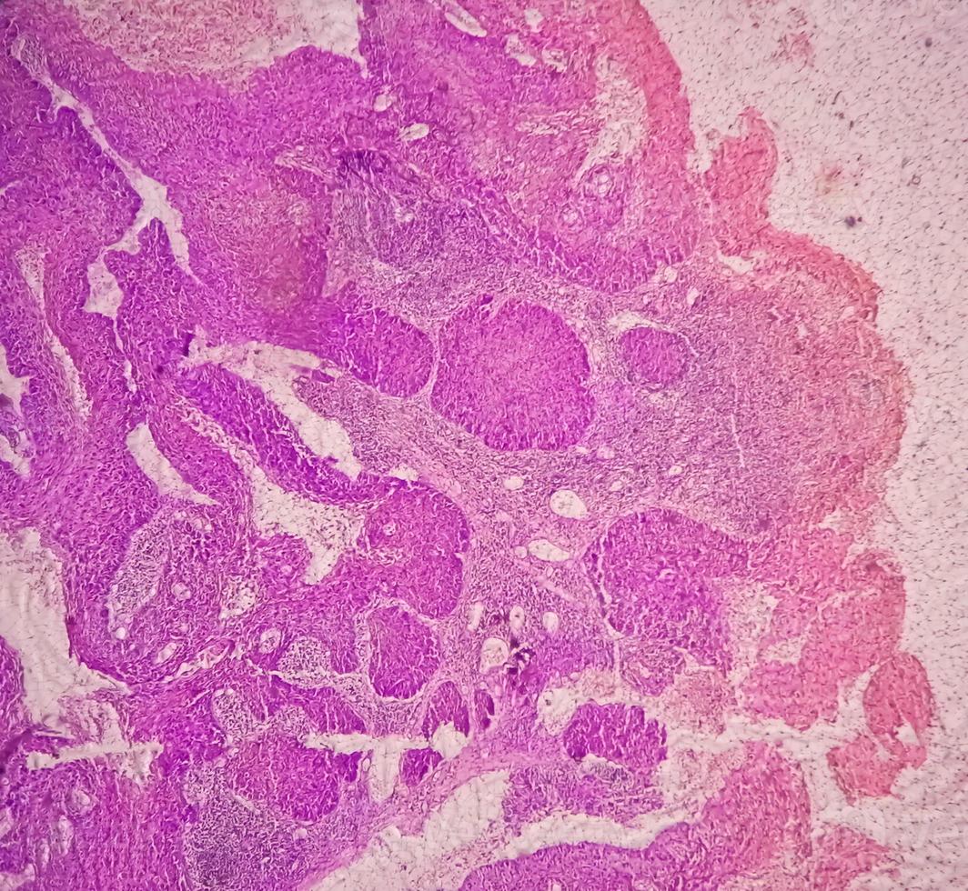 fotomicrografia mostrando carcinoma espinocelular de língua grau ii. scc invasivo oral. foto