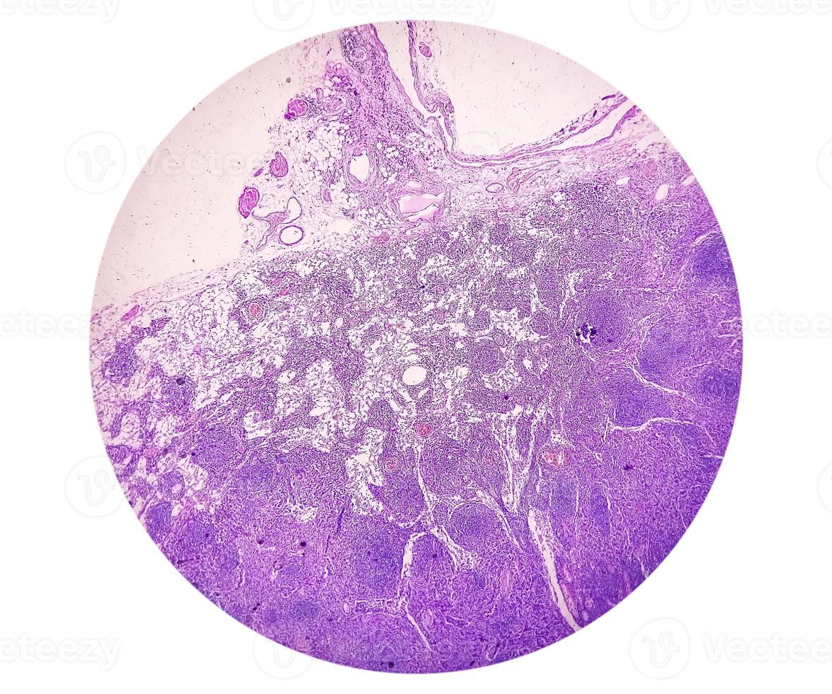 fotomicrografia de adenocarcinoma de estômago. adenocarcinoma gástrico. foto