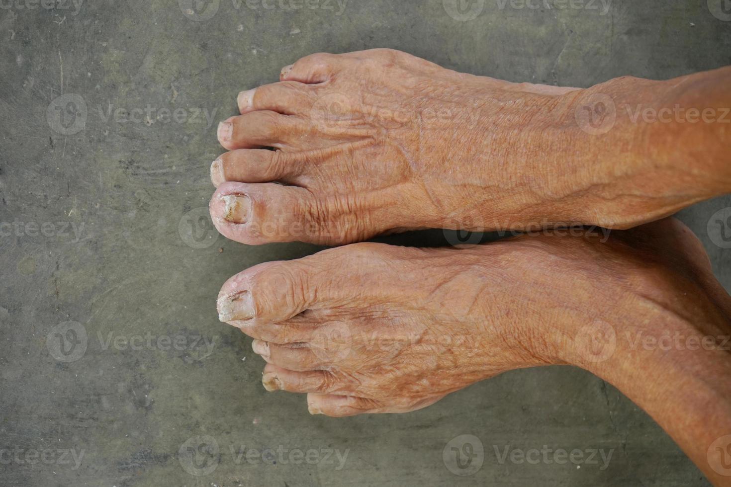 foto de um par de pés de velhos asiáticos com unhas despenteadas, vista de cima