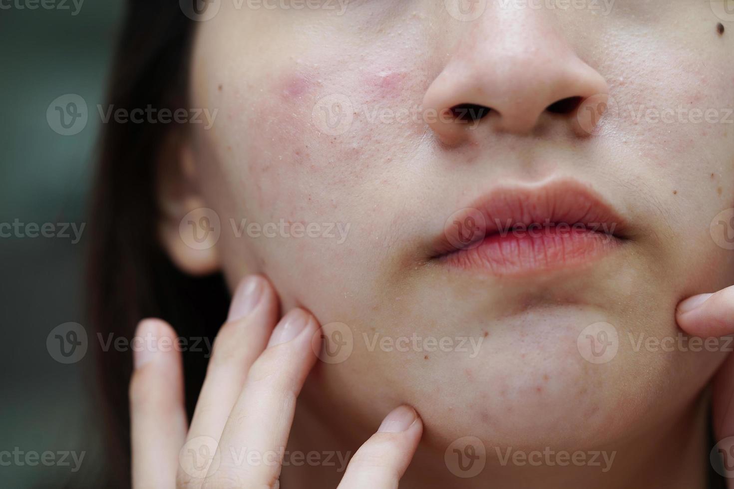 espinha de acne e cicatriz no rosto da pele, distúrbios das glândulas sebáceas, problema de beleza de cuidados com a pele de adolescente. foto