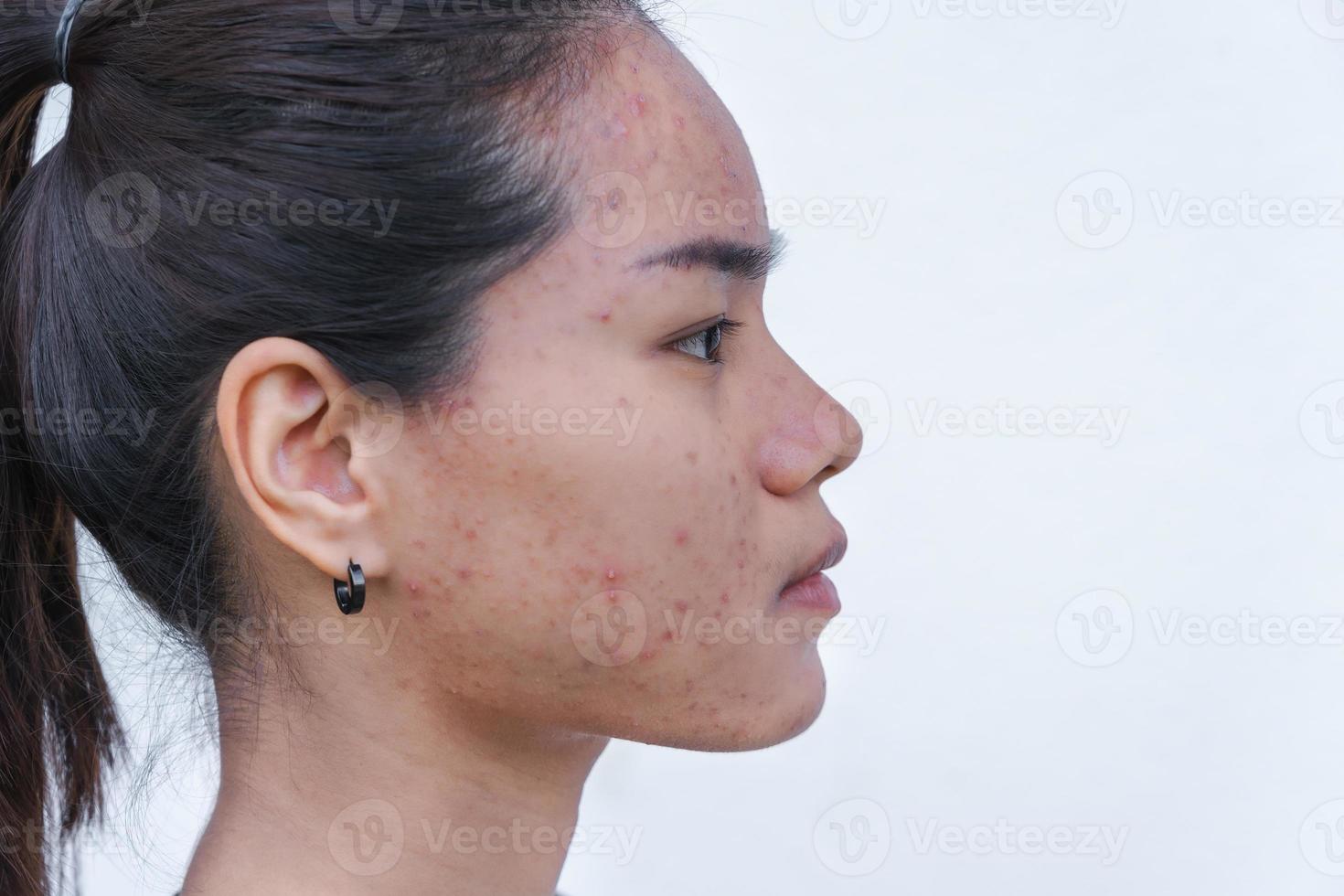 close-up da jovem asiática se preocupa com o rosto quando ela tem problemas com a pele do rosto. problemas com acne e cicatriz na pele feminina. problema skincare e conceito de saúde. foto