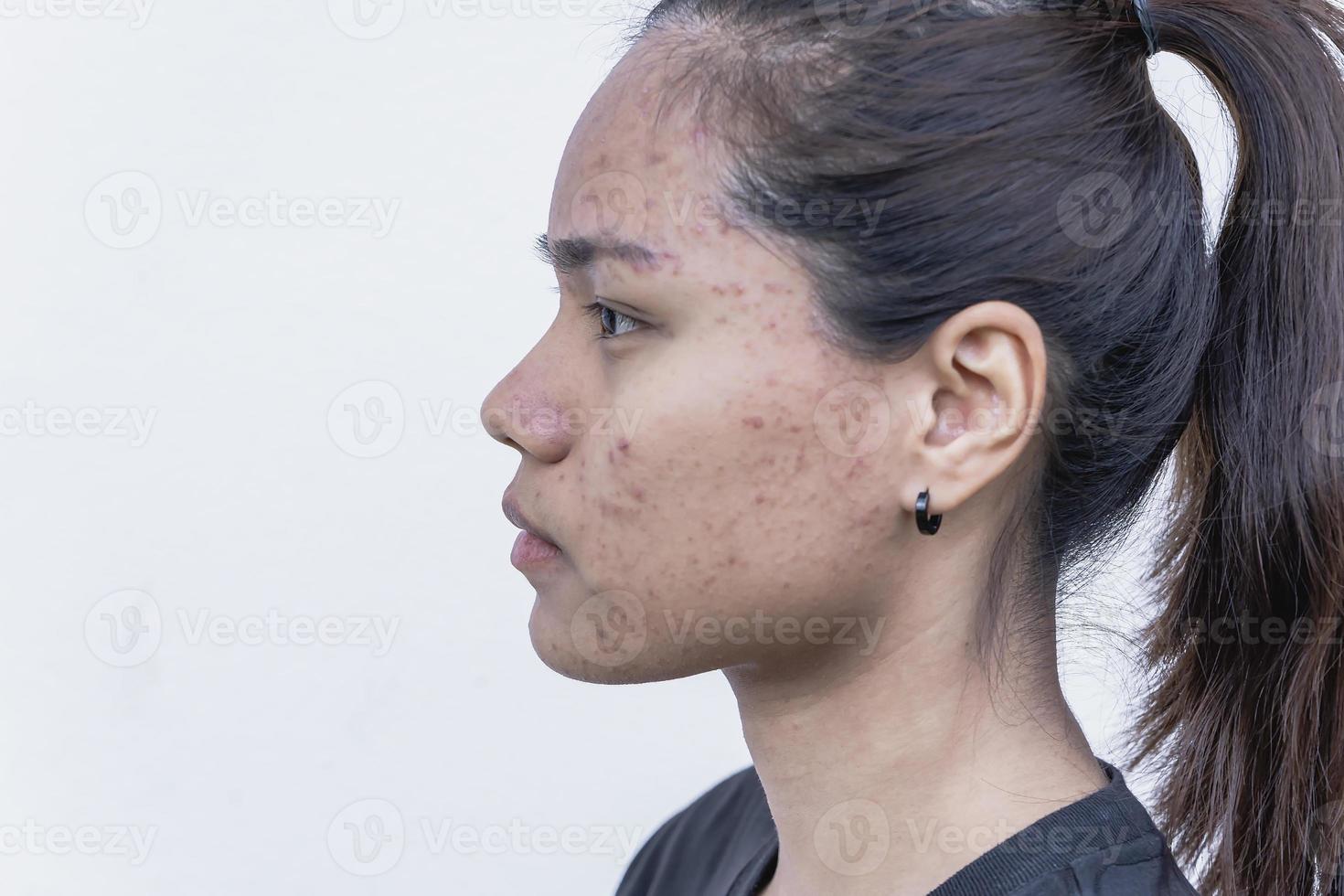 close-up da jovem asiática se preocupa com o rosto quando ela tem problemas com a pele do rosto. problemas com acne e cicatriz na pele feminina. problema skincare e conceito de saúde. foto