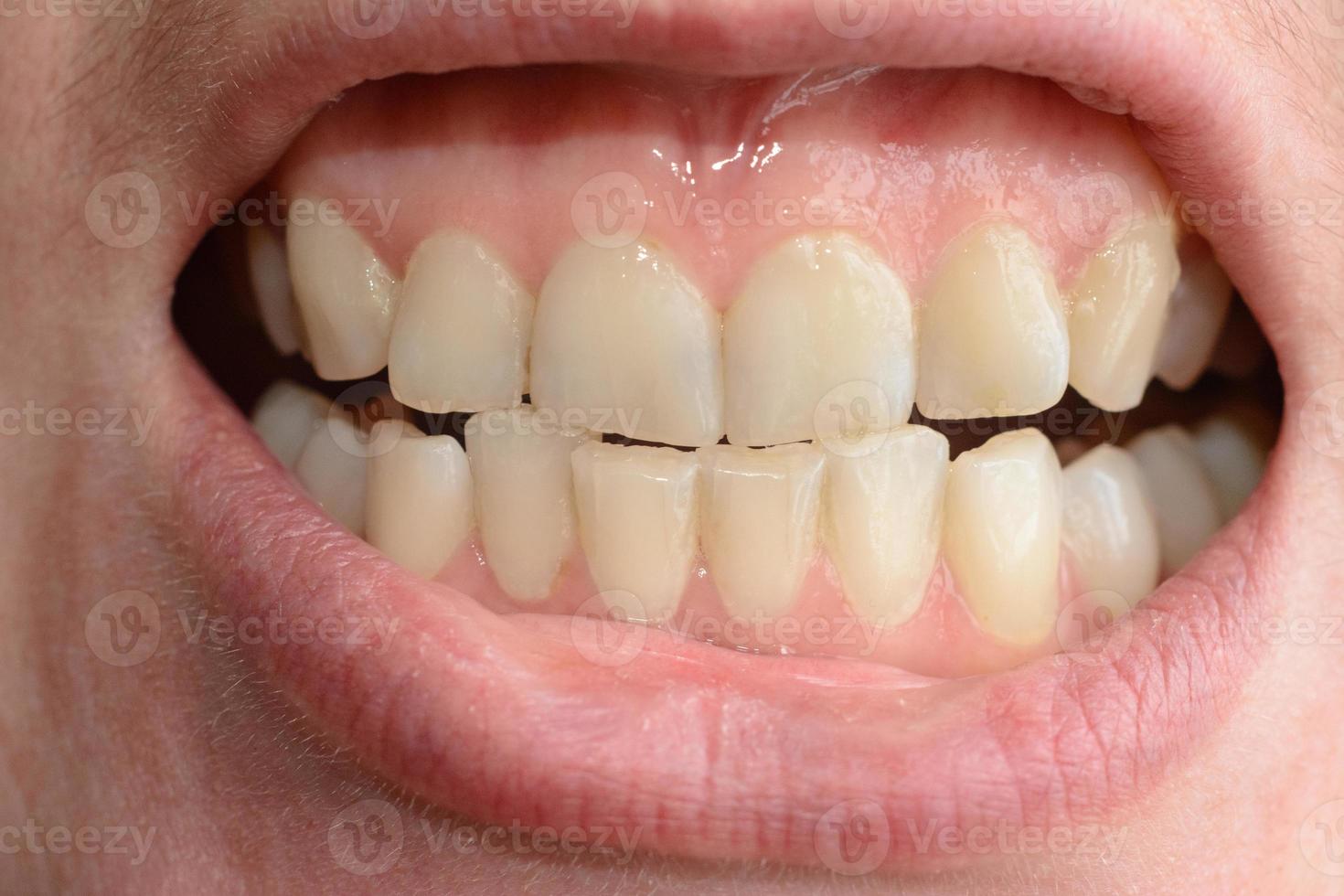 uma jovem mostra seus dentes tortos que precisam de ajuda médica em close-ups foto