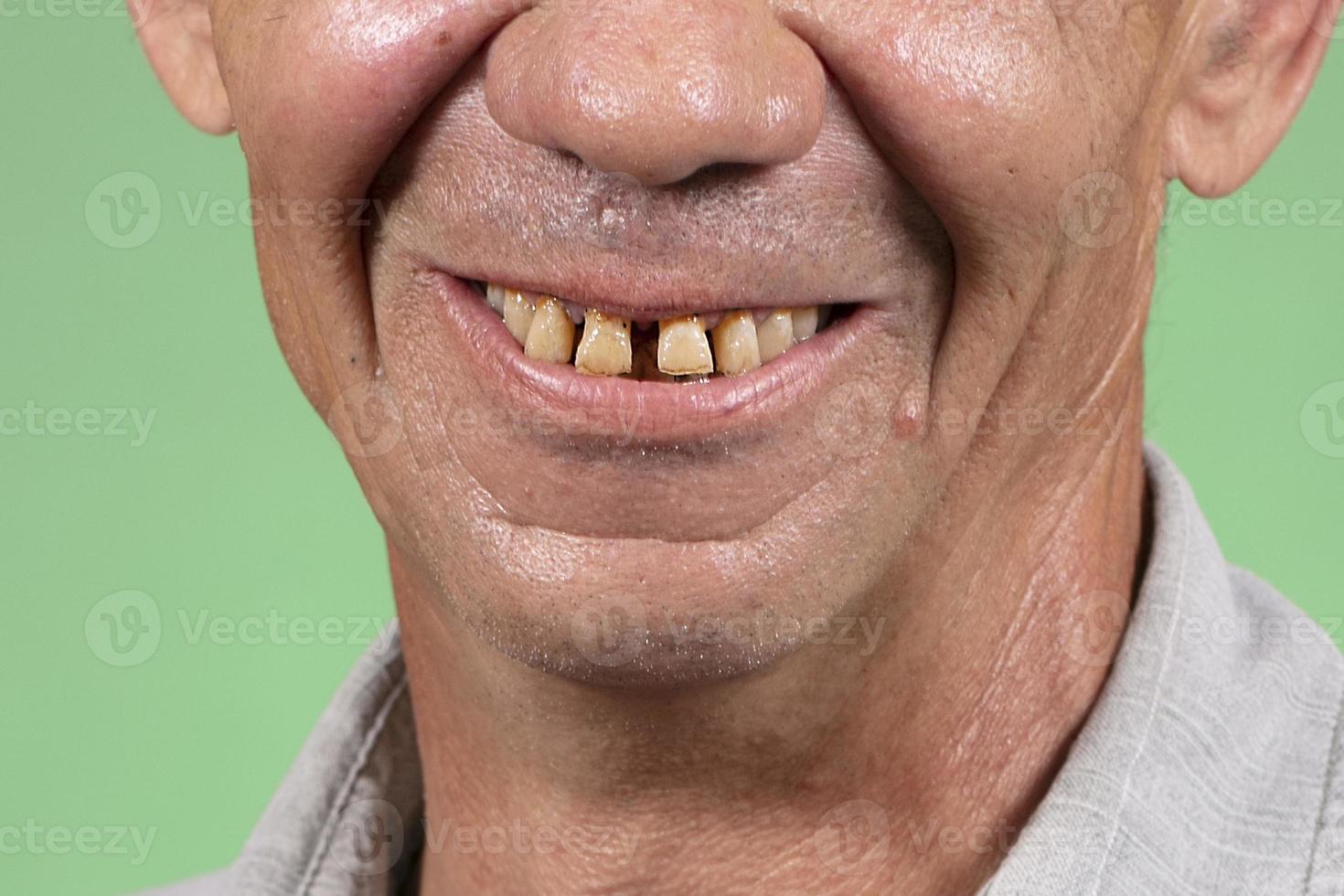 parte do rosto com dentes esparsos e amarelos feios. problemas dentários dos dentes anteriores em uma pessoa idosa boca sorridente de um homem com close-up de dentes amarelos tortos foto