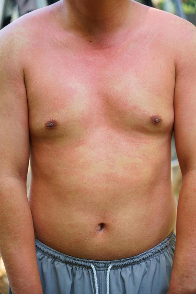adulto do sexo masculino com alergia alimentar de início agudo com urticária em todo o corpo foto