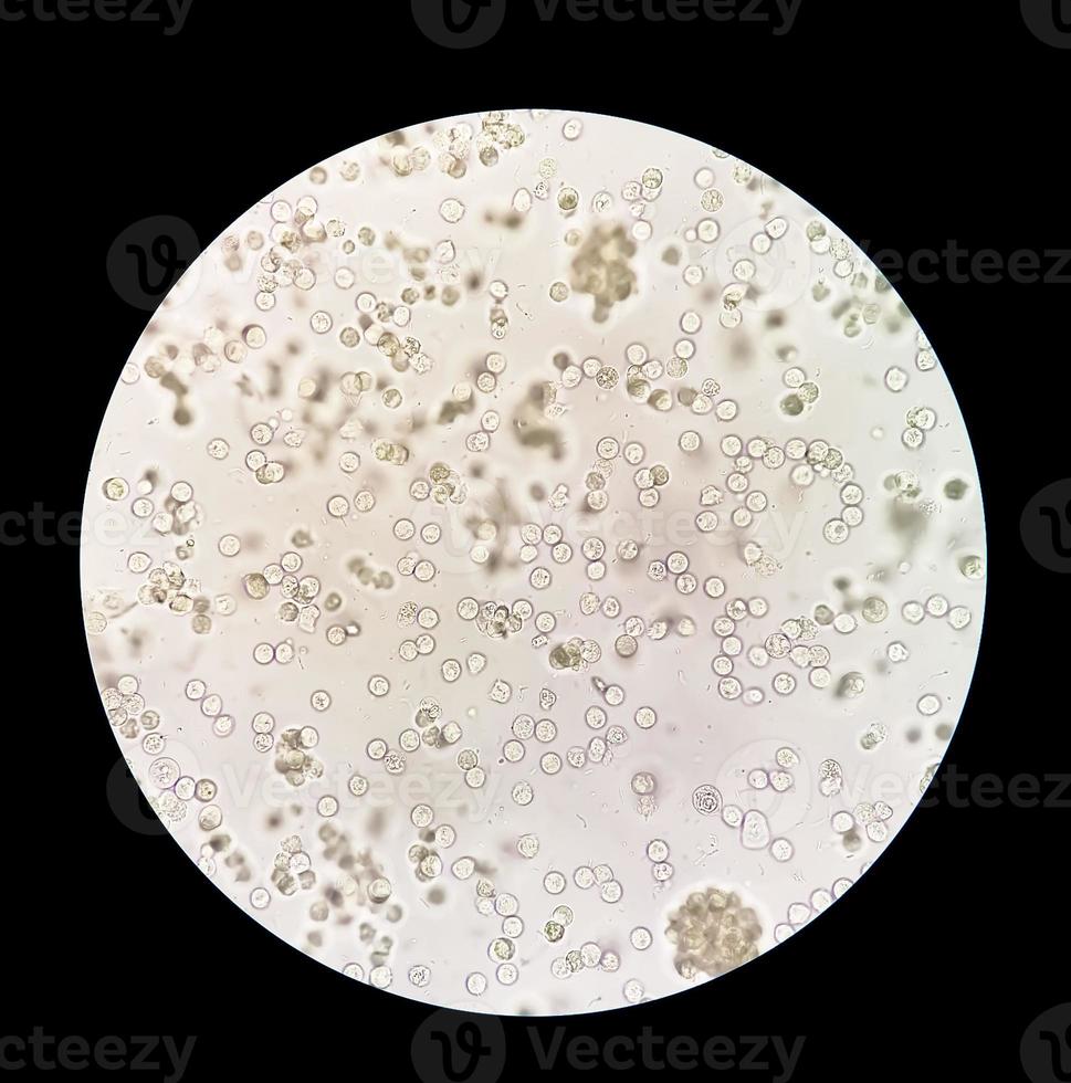 piúria ou leucocitúria é a condição do urina contendo branco sangue células ou pus. isto pode estar uma placa do uma bacteriano urinário trato infecção foto