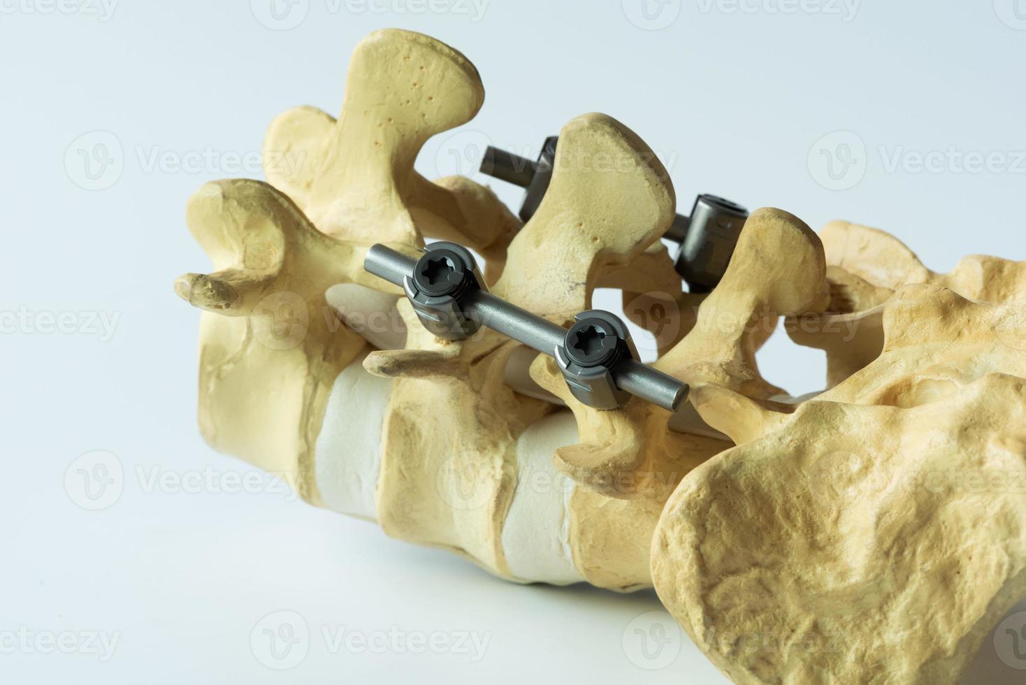 modelo do instrumento fixação do lombar coluna vertebral foto