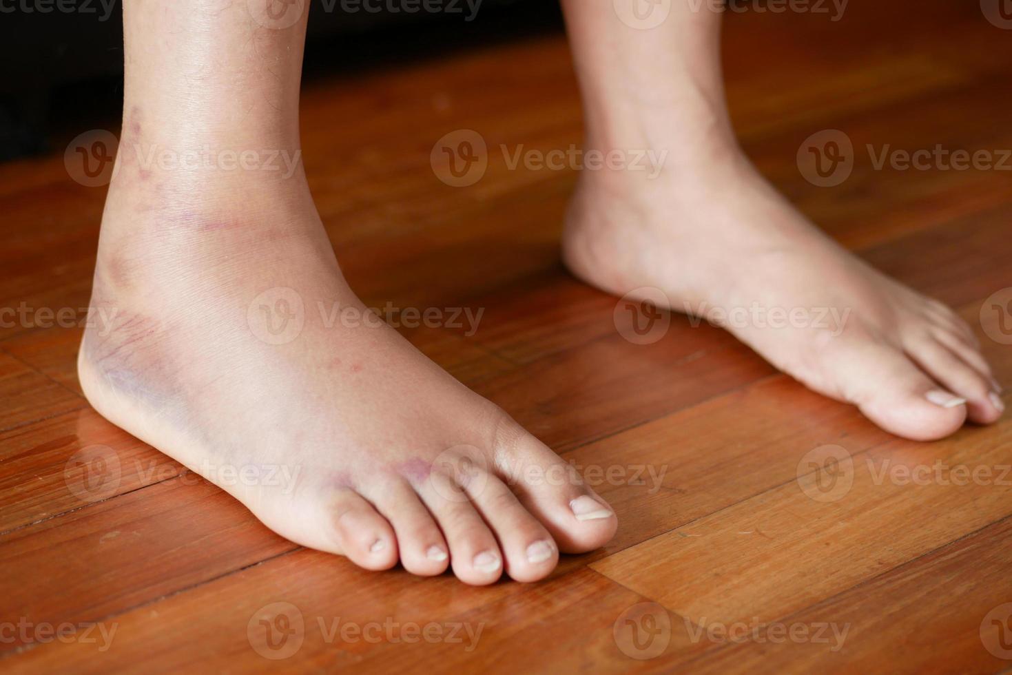 close-up de pés de mulheres com inchaço foto