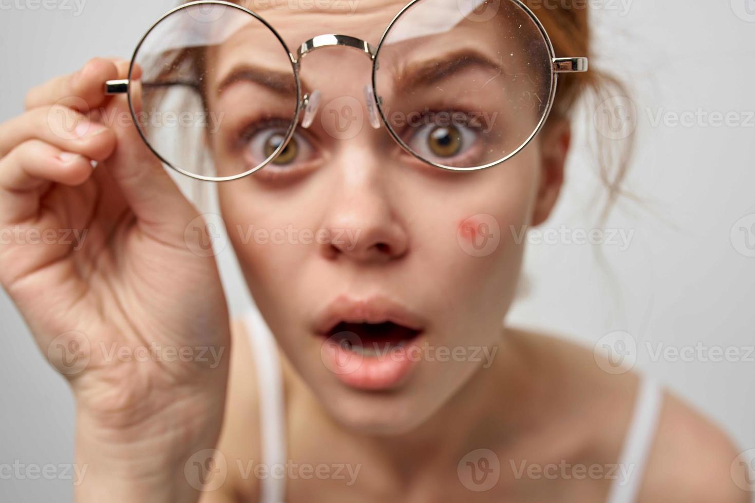 surpreso mulher com espinha em dela face dermatologia limpar \ limpo pele tratamento foto