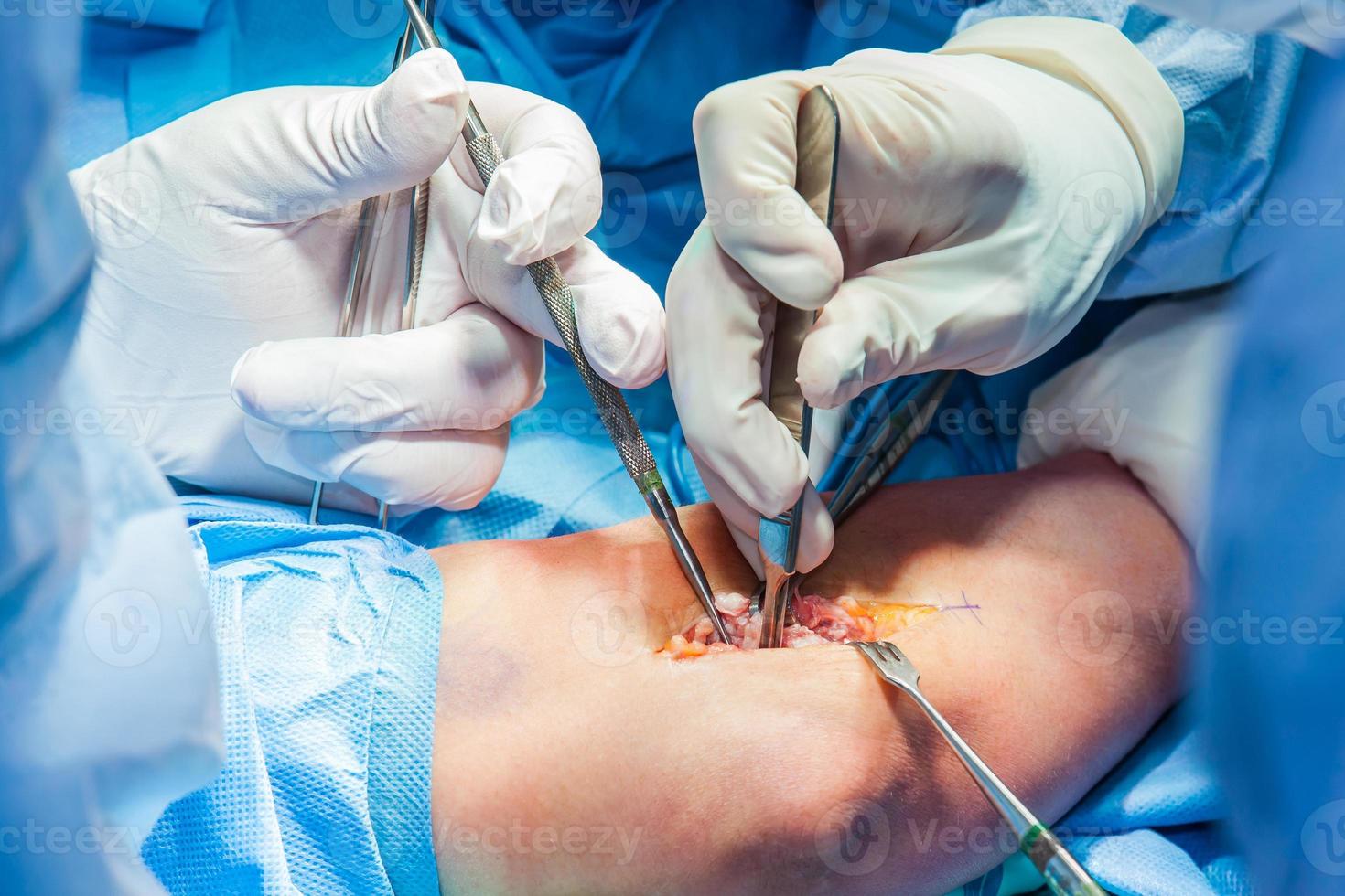 grupo do cirurgiões realizando a cotovelo cirurgia foto