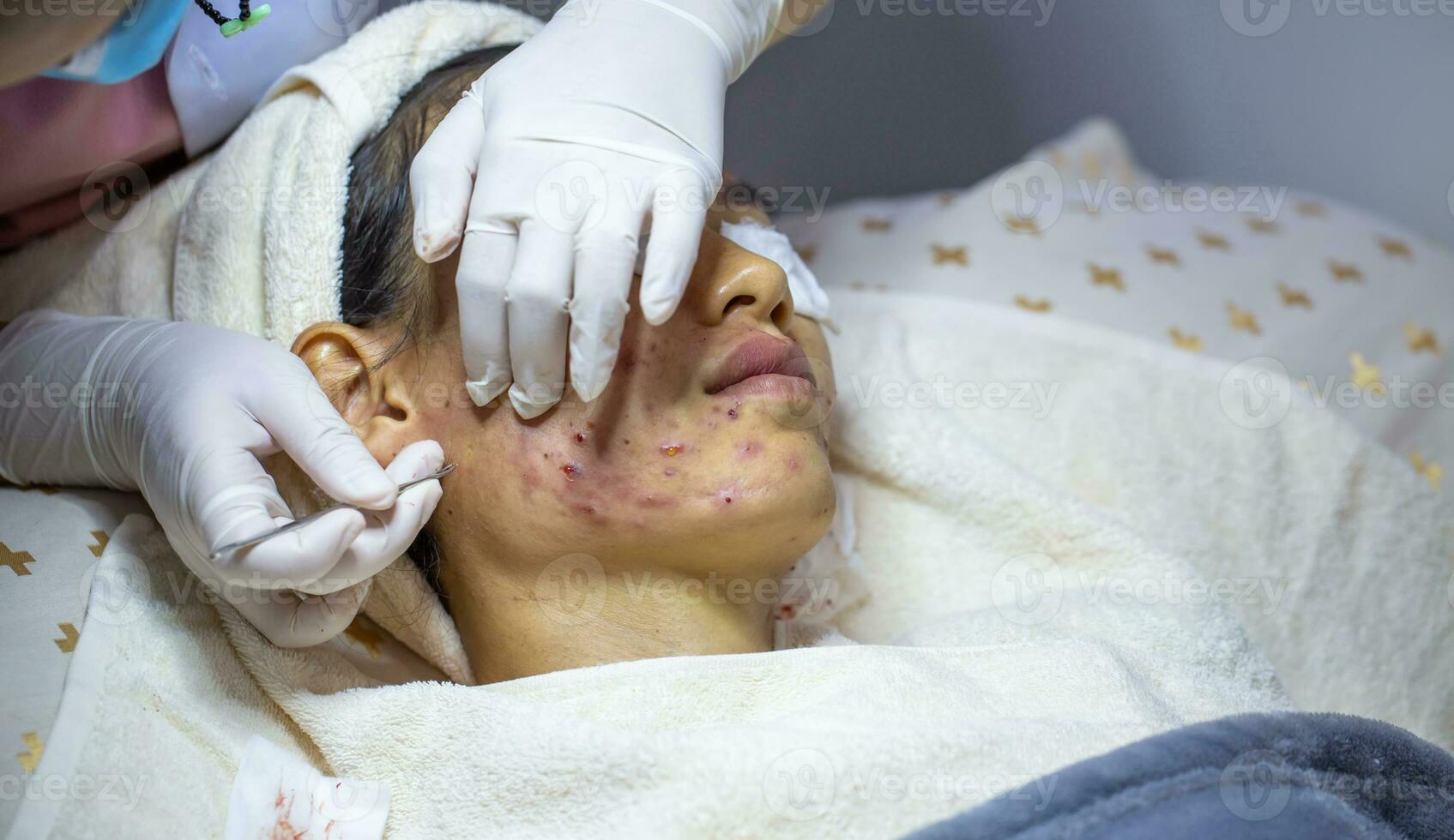jovem mulher pressionando espinhas às a clínica. problemas este mulheres preocupação sobre pele inflamação. beleza dentro mulheres. foto