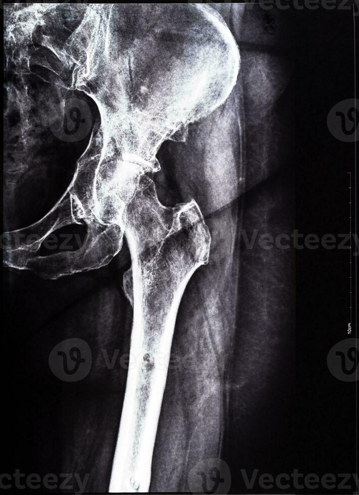 negativo raio X do junção do tíbia e pélvis foto