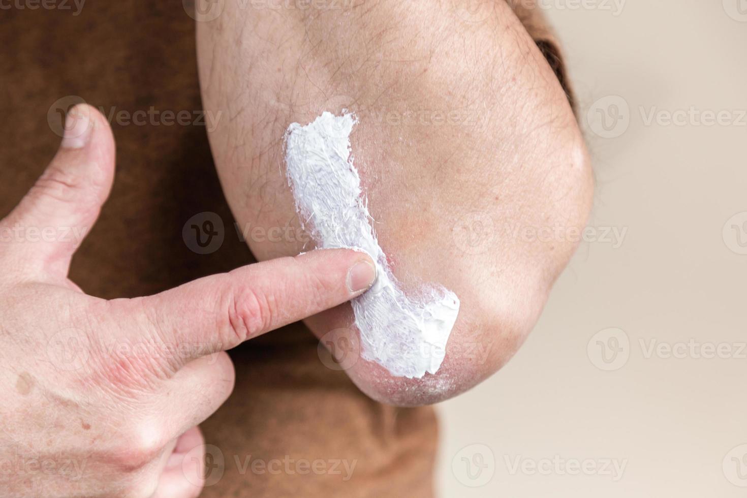 tratamento com pomadas de psoríase de doenças de pele usando pomadas como forma farmacêutica de medicamento foto