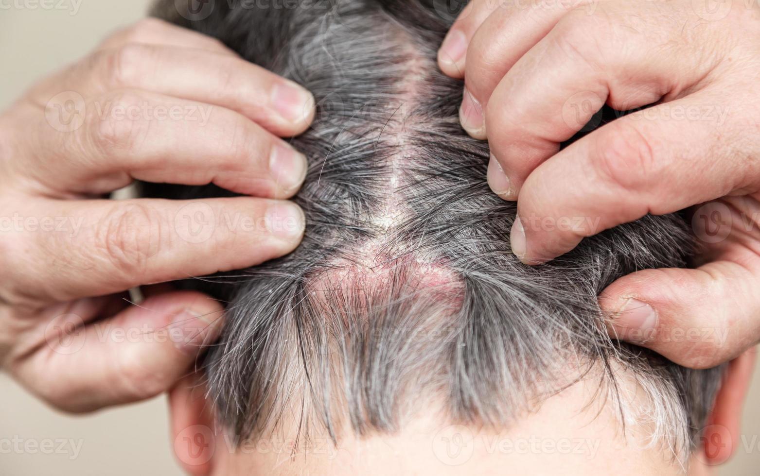 doença psoriática da pele no cabelo foto