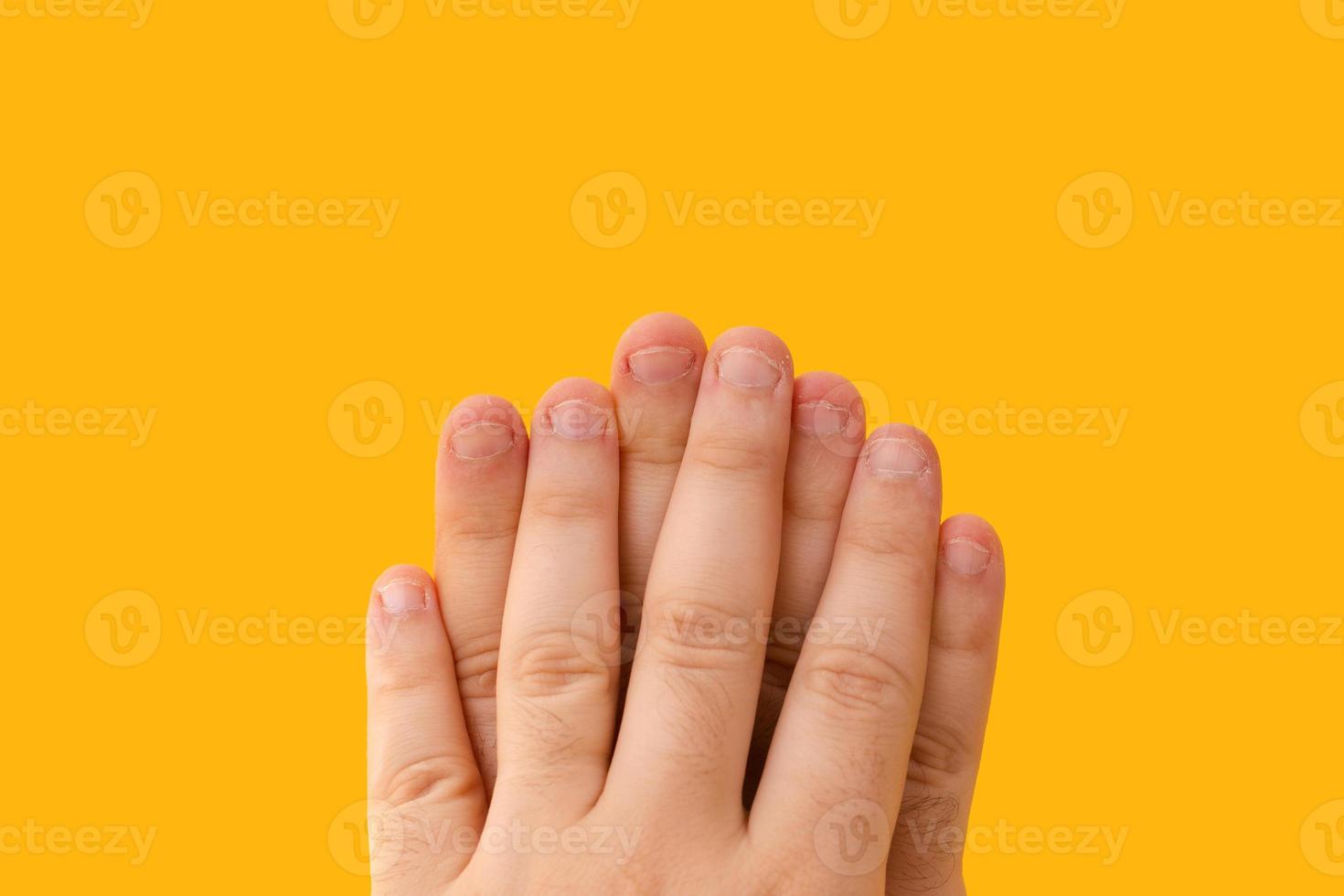 dedos com unhas roídas isoladas em um fundo amarelo foto