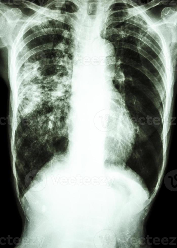 radiografia de tórax mostra infiltrado alveolar no pulmão direito devido a infecção por Mycobacterium tuberculosis tuberculose pulmonar foto