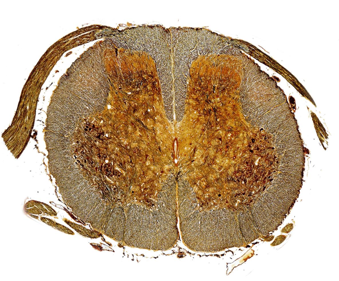 mancha de prata da medula espinhal foto