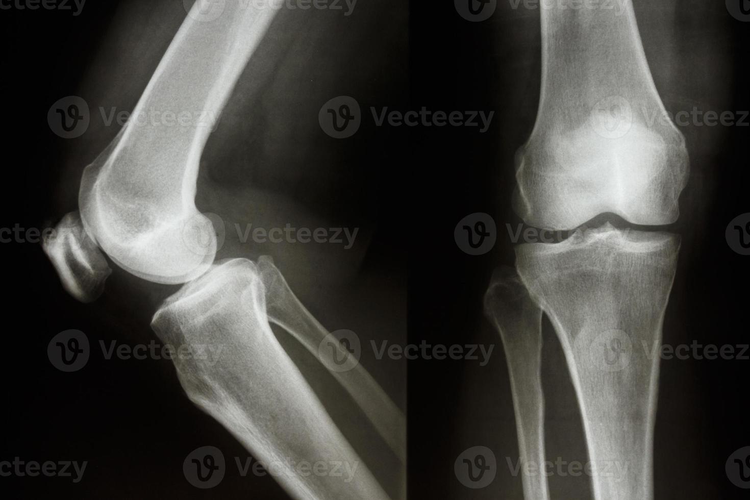 o raio-x do filme mostra a articulação do joelho normal foto