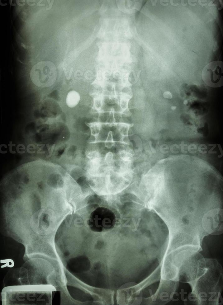o raio x do filme mostra pedra renal bilateral redonda em forma de lado direito e esquerdo foto