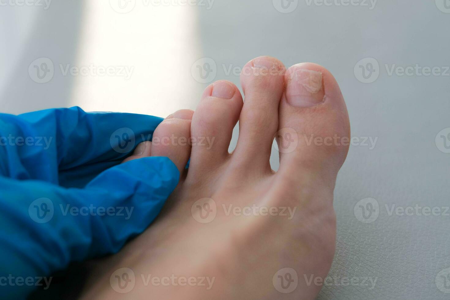 uma fechar-se do uma pé com uma fungo em a unhas é examinado de uma médico dentro luvas. onicólise destacamento do a unha a partir de a unha cama. foto