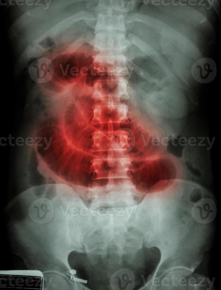 filme de obstrução do intestino delgado raio x abdômen em decúbito dorsal mostra dilatação do intestino delgado devido à obstrução do intestino delgado foto