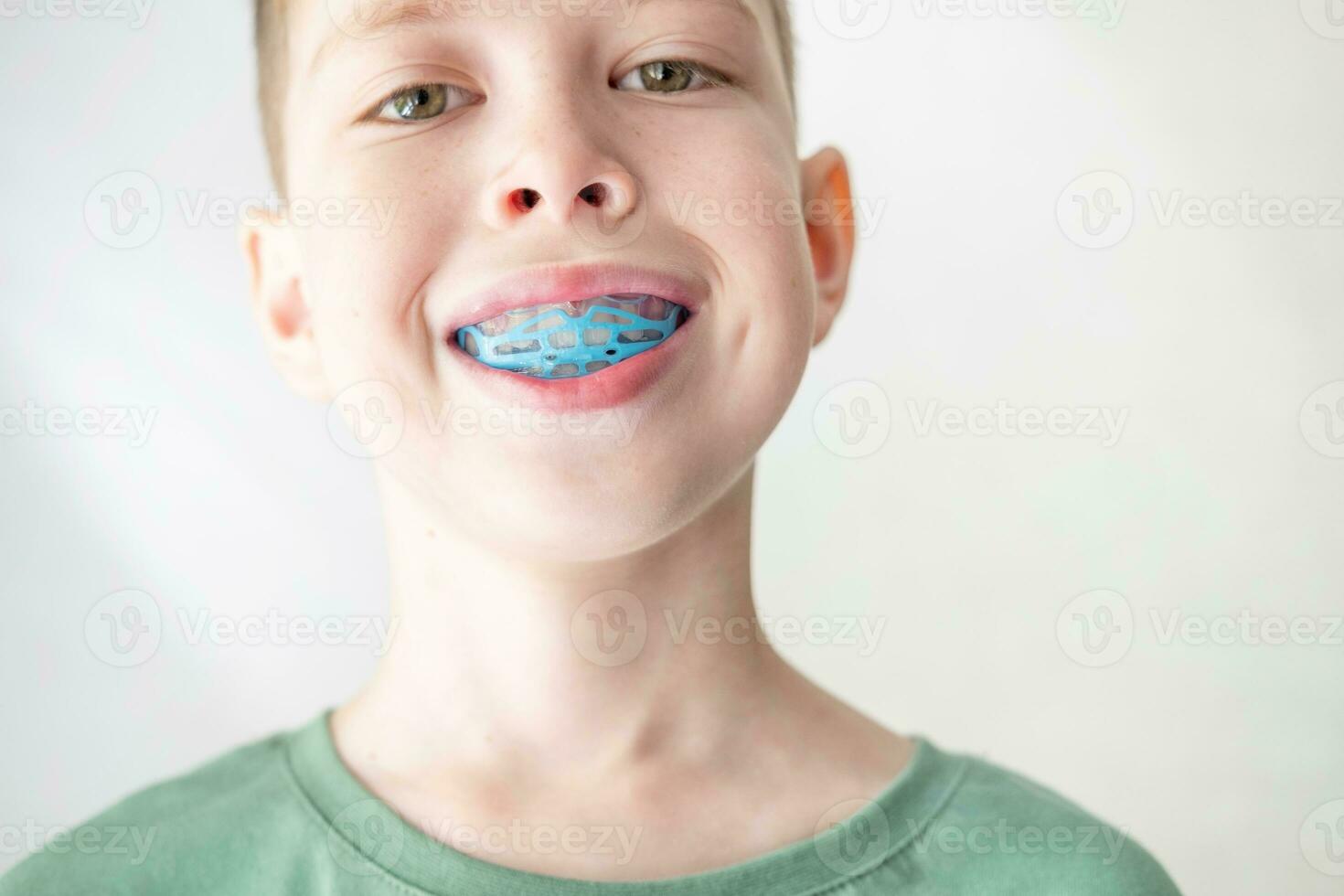 uma adolescente coloca em uma Treinamento protetor bucal para a mandíbula, fechar-se. correção do mordida a partir de infância foto