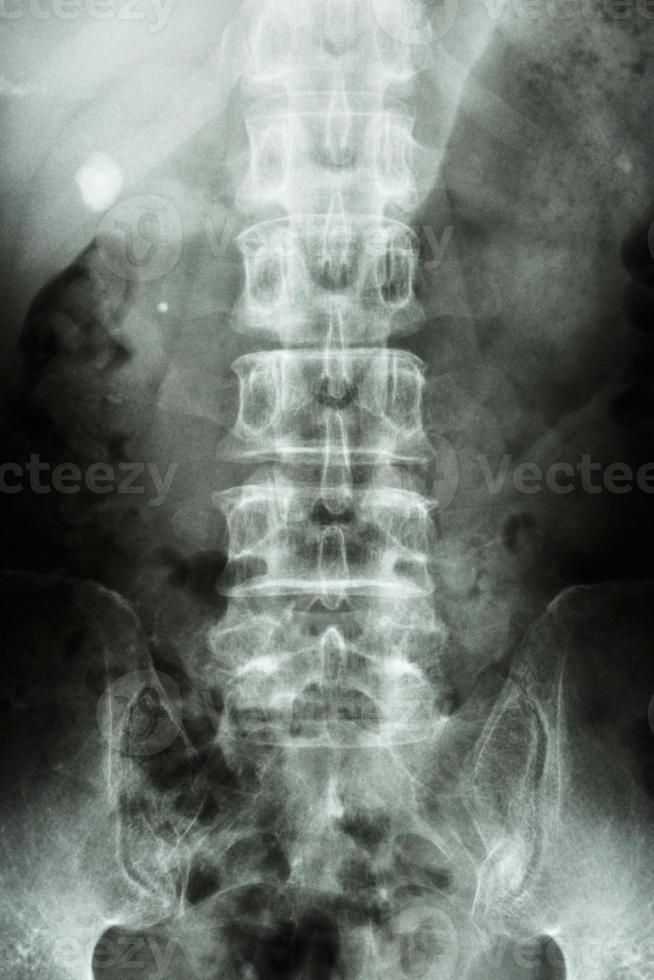 filme raio-x kub rim-ureter-bexiga mostra pedra renal direita forma redonda no lado direito foto