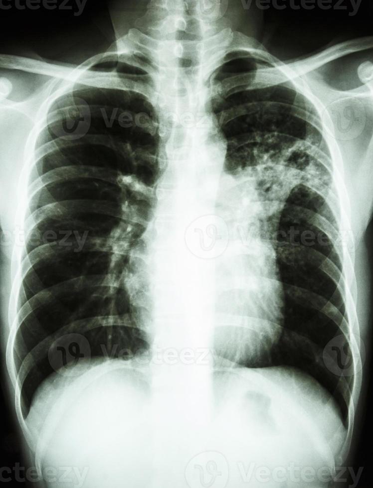 radiografia de tórax mostra infiltrado alveolar no pulmão médio esquerdo devido a infecção por Mycobacterium tuberculosis tuberculose pulmonar foto