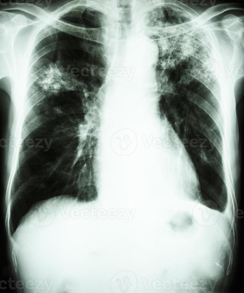 a radiografia do tórax mostra infiltrado alveolar no pulmão superior esquerdo e no pulmão médio direito devido a infecção por Mycobacterium tuberculosis tuberculose pulmonar foto