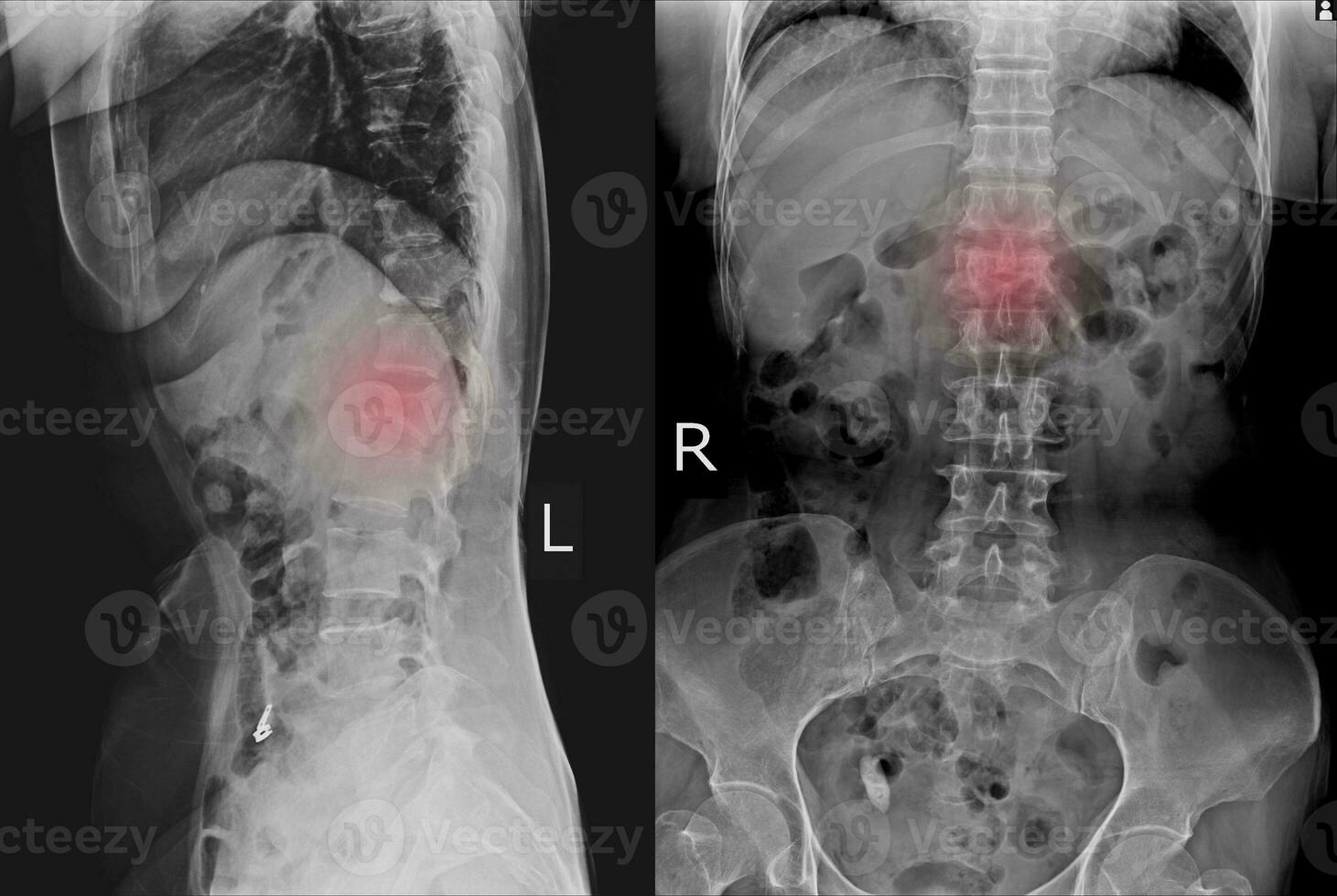 raio X ls coluna vertebral ap lateral achando moderado compressão fratura do l1 vértebra. foto